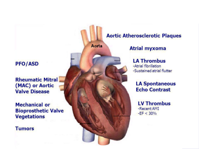 Cardiac   Source   of   Embolism